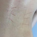 Image showing medical acupuncture treatment of a bad back