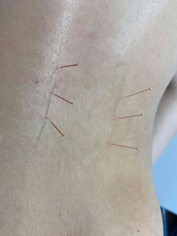Image showing medical acupuncture treatment of a bad back